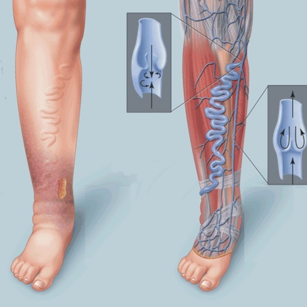 Клиники для лечения атеросклероза нижних конечностей
